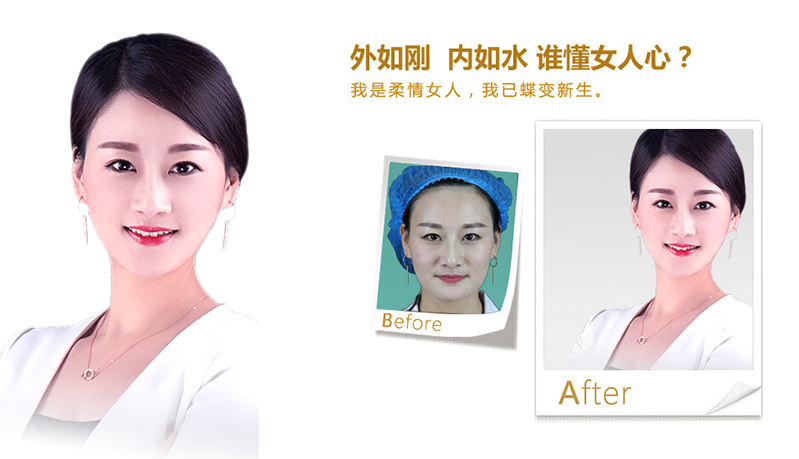 济南V脸、线雕隆鼻